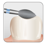 Occlusal/Lingual Reduction