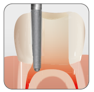 Endodontic Safe End